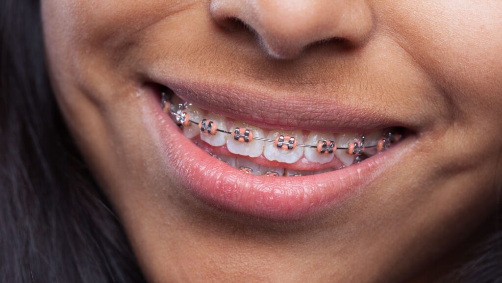 Por que o dente entorta após usar aparelho e como evitar?